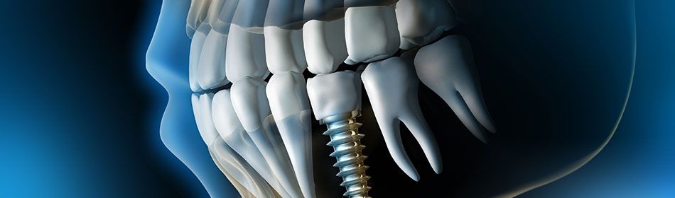 3D-Implantologie
