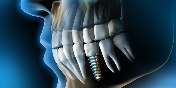 3D-Implantologie